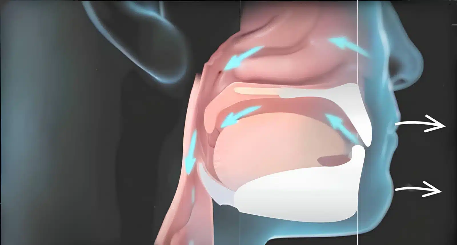 3D illustration of orthognathic surgery: Maxillomandibular advancement for sleep apnea treatment. Side view showing jaw movement and airway expansion.