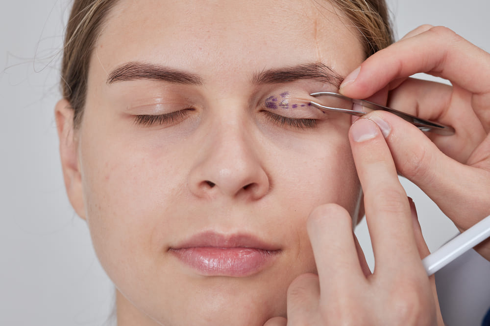 Surgeon marking patient's eyelid for blepharoplasty procedure