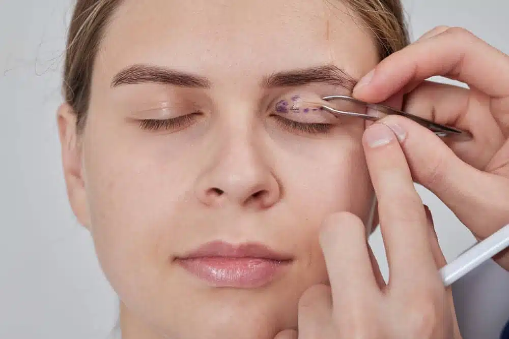 Surgeon marking patient's eyelid for blepharoplasty procedure