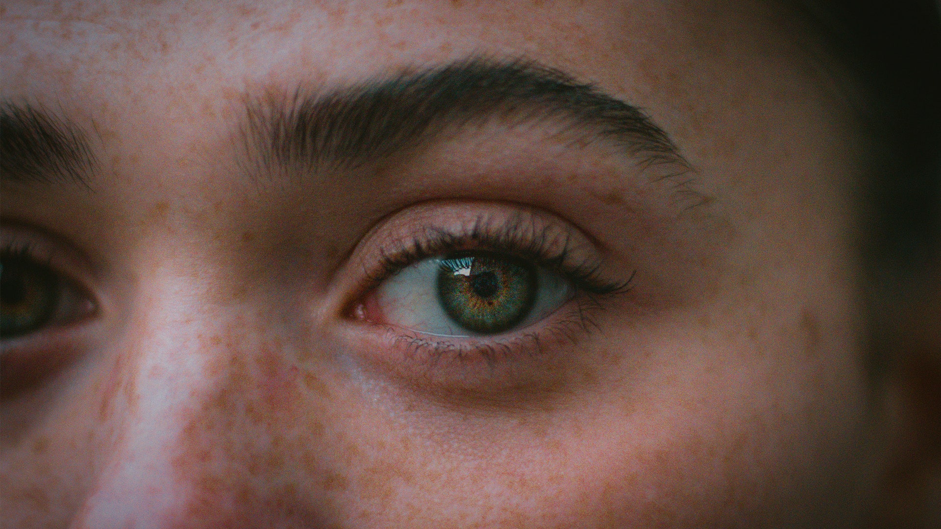 Blepharoplasty