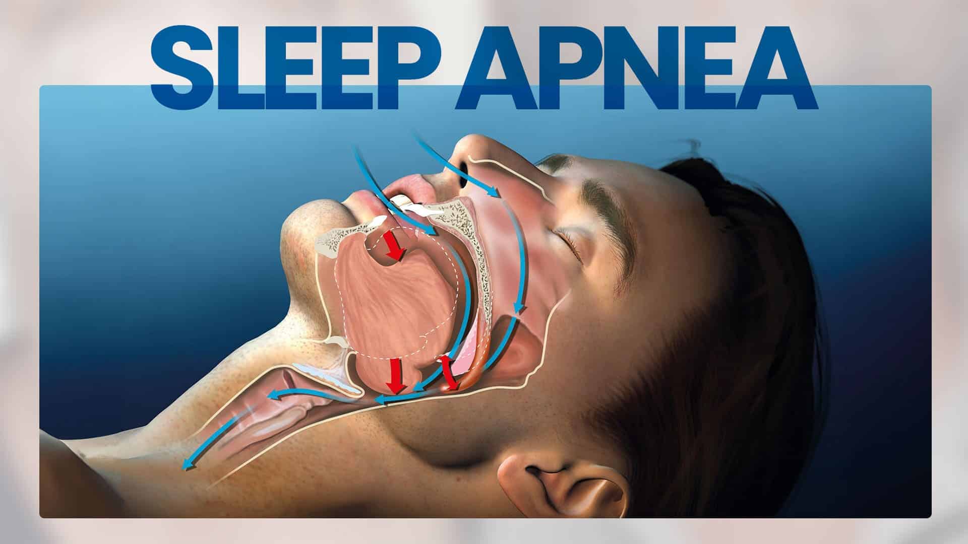 sleep apnea_img