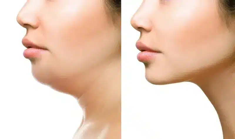 Double Chin 6e3d5a5
