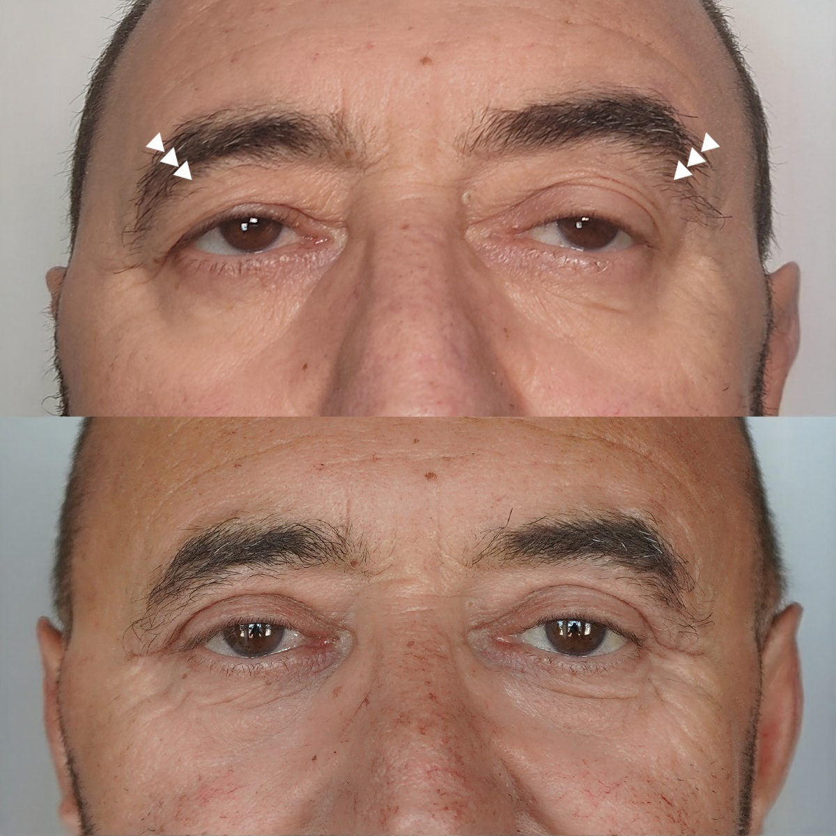 Cirurgia As Palpebras Superiores Ptose Palpebral – Blefaroplastia Ab