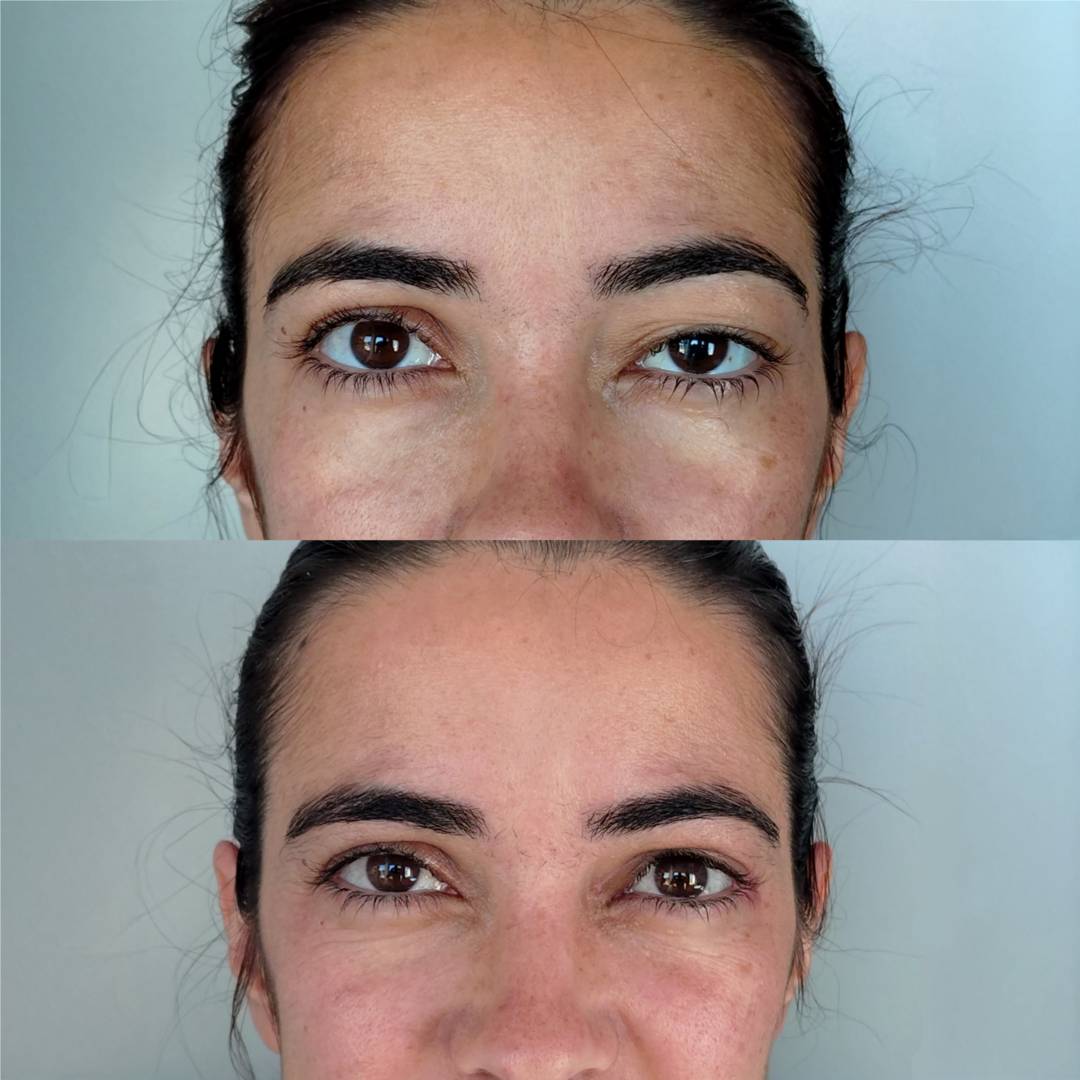 Ptose Palpebral Unilateral Congenita